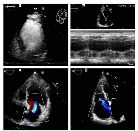 severe global hypokinesis on echocardiogram.